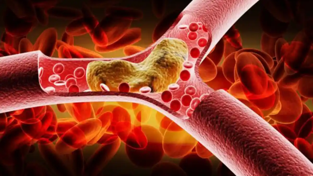 Cara Alami Menurunkan Kolesterol Jahat (LDL) Tanpa Ketergantungan Obat Secara Mudah dan Efektif